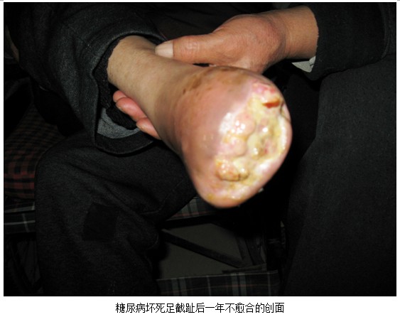 9170金沙集团_皮肤原位再生医疗手艺在首次在息县第二人民医院开课