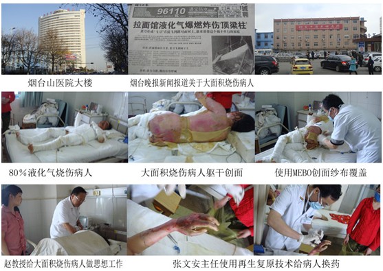 9170金沙集团_再生回复手艺烟台大面积烧伤紧抢救治再谱新华章