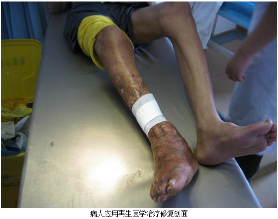 9170金沙集团_皮肤原位再生医疗手艺走进河南省新乡医学院第三隶属医院